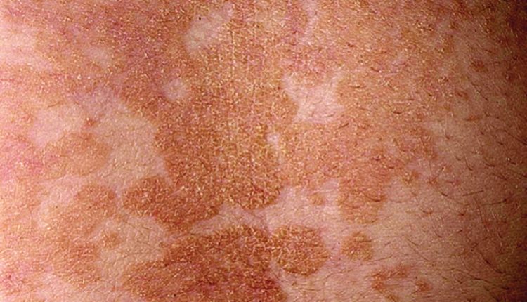 jak wygląda łupież pstry