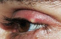 fotka przedstawiajaca przypadlosc